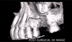Lateral sinus lift with emi-maxilla reconstruction